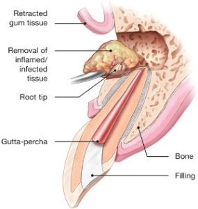 Surgical Endodontics